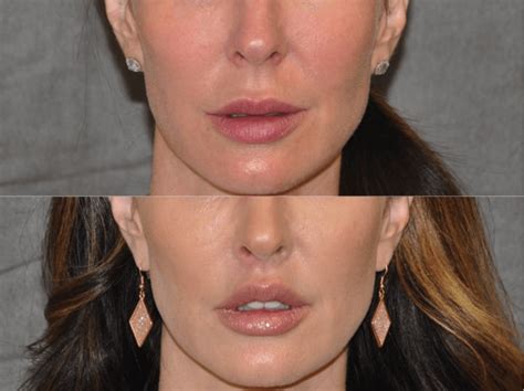 Lip Lift Surgery | Celebrity plastic surgery, Lip surgery, Eyebrow grooming