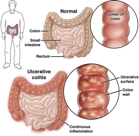 Ulcerative colitis - AGA GI Patient Center