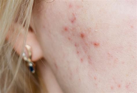 Cystic Acne: Causes, Symptoms, & Medical Treatment