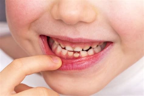 Loose Tooth: Causes, Risks, and What to Do When Teeth Are Loose - Care ...