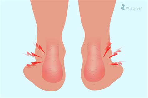 Psoriatic Arthritis in the Ankle: Symptoms, Causes, Treatments