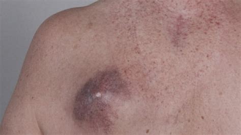 What Is Stage 4 Melanoma Skin Cancer - CancerWalls