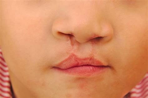 Cleft Lip and Palate: MedlinePlus