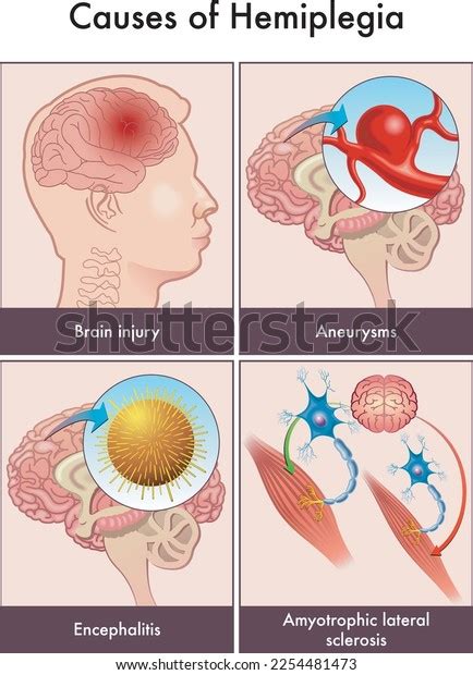 Medical Illustration Main Causes Hemiplegia On Stock Vector (Royalty ...