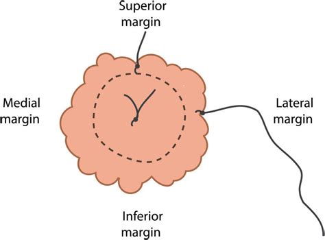 The mastectomy specimen margins are marked superior and lateral with ...