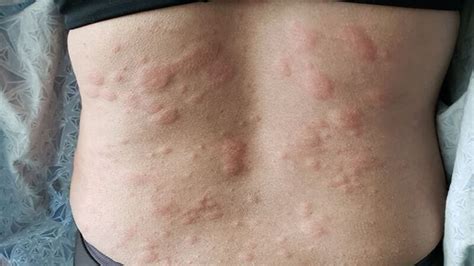 Is Liver Disease Causes Itchy Skin Danger? - Diag