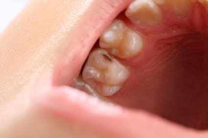 What Causes Tooth Decay - Dentists - TalkLocal Blog — Talk Local Blog