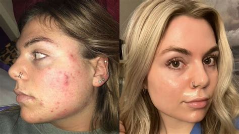 Tretinoin Before And After Pictures & Videos - Drug Genius