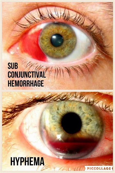 Subconjunctival hemorrhage v. Hyphema | Natural remedies for arthritis ...