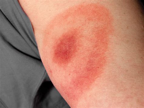 5 Common Tick Bite Symptoms, and 8 Ways to Prevent Getting Bit