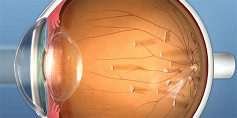 Floaters In The Eye Treatment Symptoms And Causes