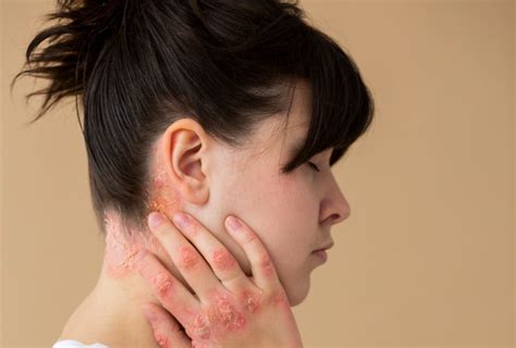 Understanding Psoriasis Behind the Ear: Causes, Symptoms, and Treatmen ...