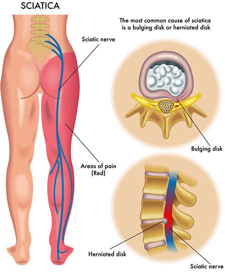 Lower Back Pain Treatment NYC | Lower Back Pain Doctors Specialists