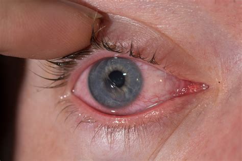 Corneal Abrasion- Symptoms, Causes, and Treatment