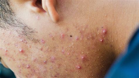 Papules Acne On Chin