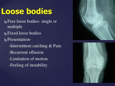 Loose Body In Knee - slidesharetrick