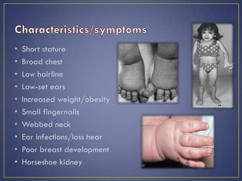 PPT - Turner Syndrome PowerPoint Presentation, free download - ID:2600553