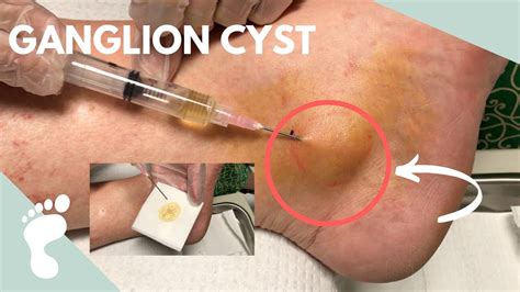 Ganglion Cyst Aspiration