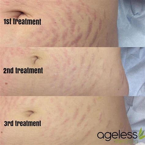 Laser Stretch Mark Removal – Does It Really Work?