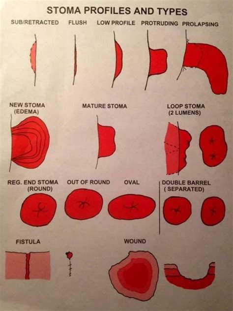 Stoma Types | Wound care nursing, Surgical nursing, Wound care