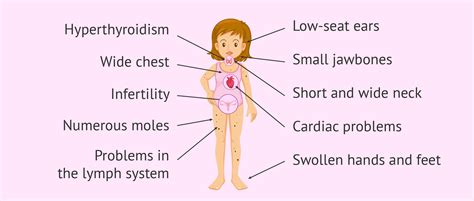 What is Turner syndrome? Its causes, characteristics and pregnancy