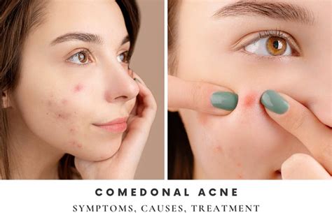 Comedonal Acne - Symptoms, Causes, Treatment, and Tips