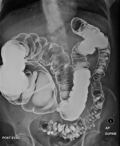 Diverticulitis Treatment - Maher A. Abbas, MD