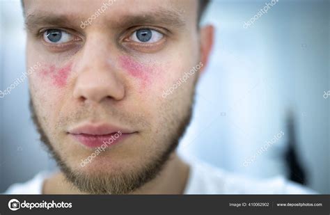 Age Spots Redness Face Young Man Sick Systemic Lupus Erythematosus ...