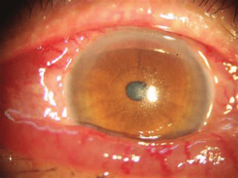 Slit lamp examination images of both eyes show conjunctival hyperemia ...