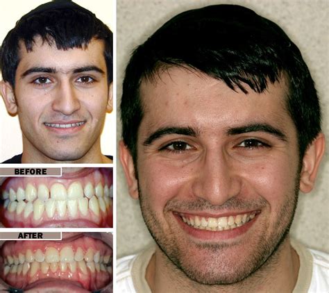 Palate Expander Before And After