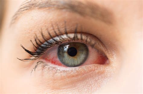 10 Causes & Treatments for Eye Redness | Niagara Falls, ON