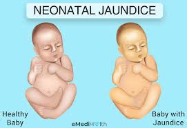 Jaundice Newborn Treatment