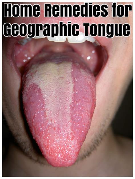 Top 10 Home Remedies for Treating Geographic Tongue