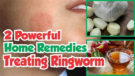 2 Powerful Home Remedies For Treating Ringworm - YouTube