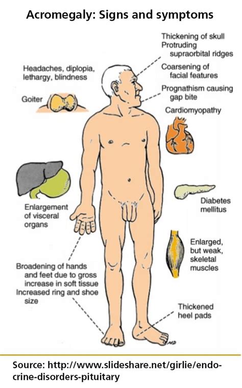 Acromegaly signs and symptoms | Nursing school survival, Pharmacology ...