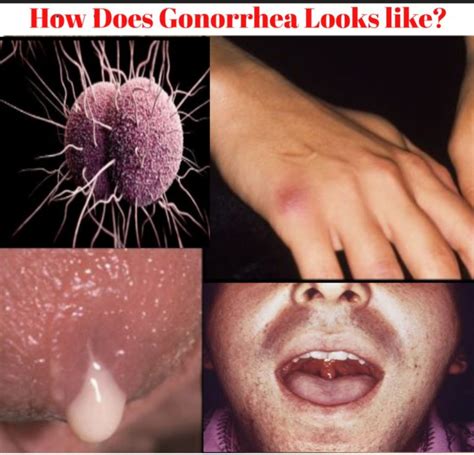 What Gonorrhea Looks Like (Pictured) - Public Health