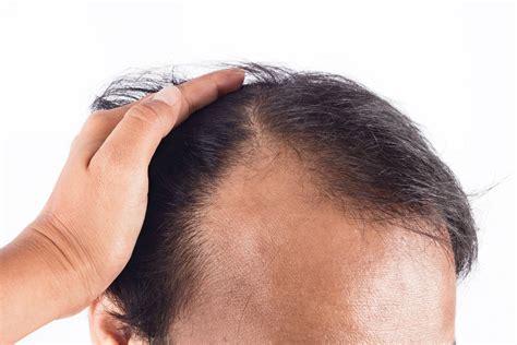 May gamot para pigilan ang buhok na nakakalbo? | Mediko.ph