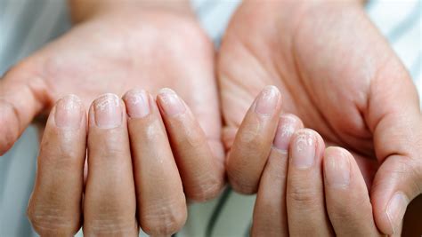 Signs You May Have Eggshell Nails (& What To Do About It)