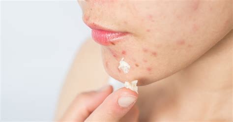 What to Do After Popping a Pimple: Tips and Treatments | POPSUGAR Beauty