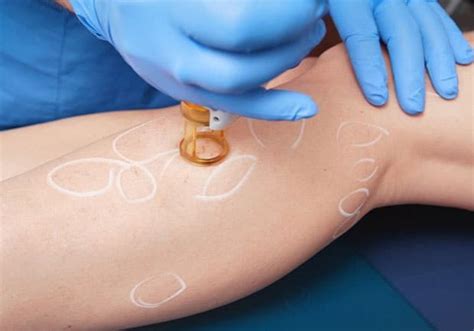 Laser Vein Treatment - Oakbrook Advanced Aesthetics