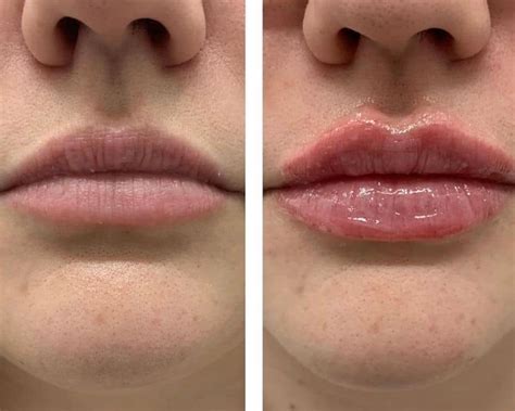 Lip Filler vs Lip Flip