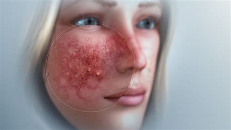 Rosacea: Types, Causes, and Treatment - Scientific Animations