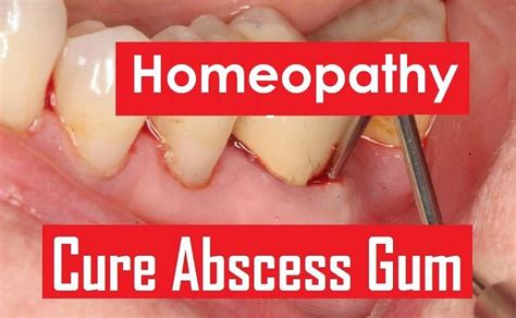 8 Images Tooth Abscess Treatment Homeopathic And Description - Alqu Blog