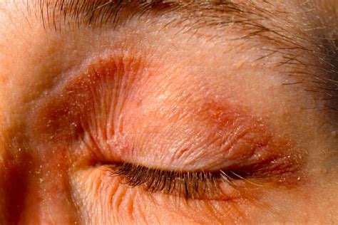 Eyelid Eczema (Eyelid Dermatitis): Symptoms, Causes, and Treatment ...