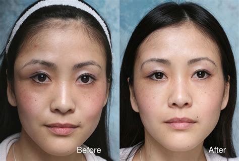 Asian Anime Eye Plastic Surgery : Asian Celebrities Plastic Surgery ...