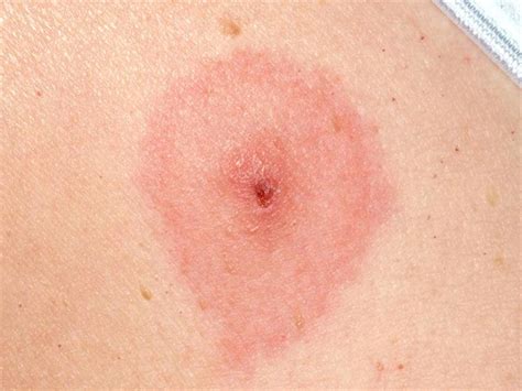 Hikers urged to be cautious of tick borne diseases | Kempton Express