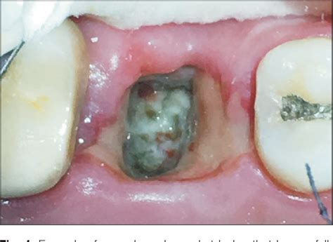 Dry Sockets In Teeth