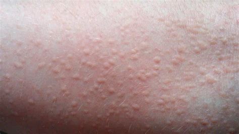 Why Is My Face Itchy With Little Bumps | Allergy Trigger