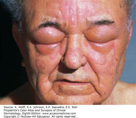 Acute Urticaria and Angioedema | AccessMedicine Network