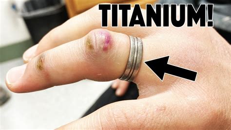 Cutting a Ring off a BROKEN finger - YouTube